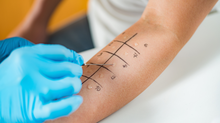 Patient undergoing allergy testing on their arm