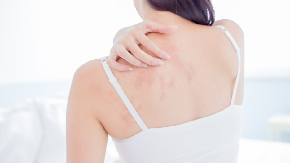 Woman scratching autoimmune rash on her shoulder and back