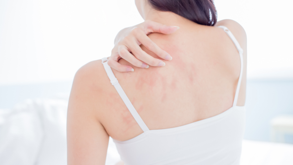 A rash on the chest and back - Clinical Advisor