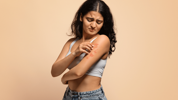 Woman with poison ivy rash on arm, illustrating how long poison ivy lasts and common skin symptoms